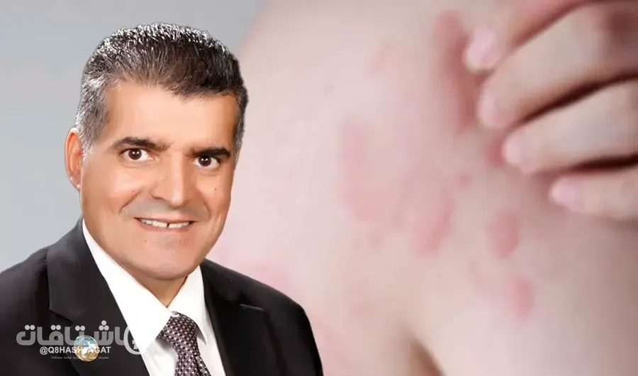 انطلاق فعاليات يوم الإكزيما العالمي في مستشفى جابر